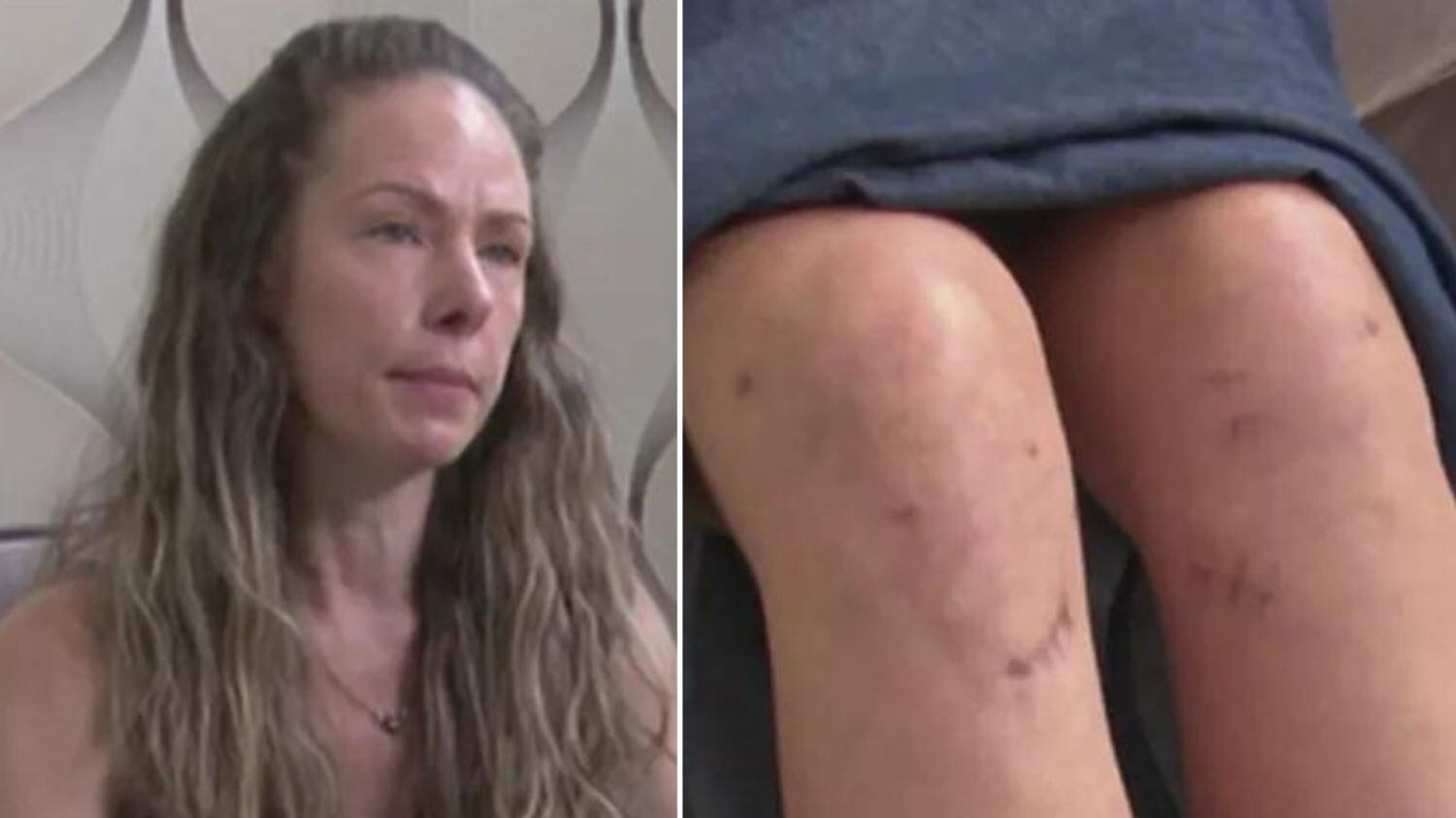 Ela teve que passar por outro procedimento