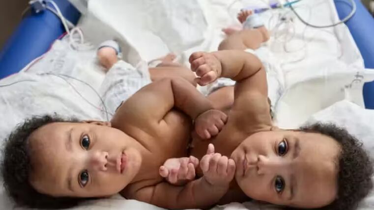 Gêmeos siameses são separados após cirurgia de 8 horas nos EUA