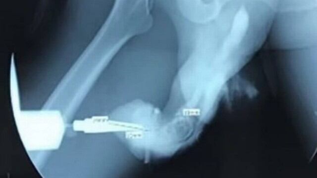 Homem fratura pênis durante sexo 'intenso'