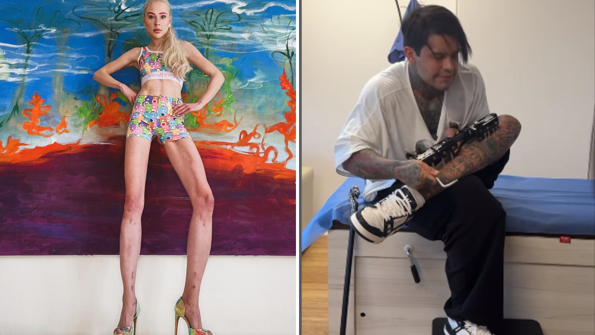 Algunos influencer han optado por una doloroso cirugía en la que se quiebra el fémur para alargar el hueso y ganar talla.