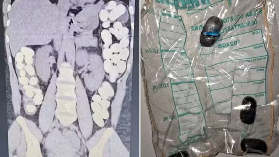 Ela segue internada em UTI e é investigada pela polícia