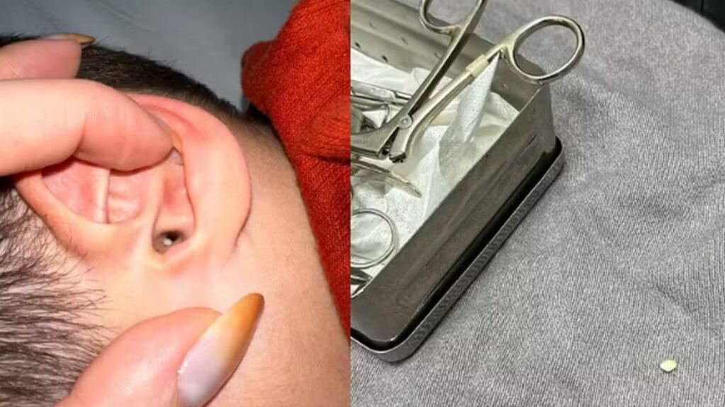 Menino é internado após bolinha de isopor ficar presa no ouvido